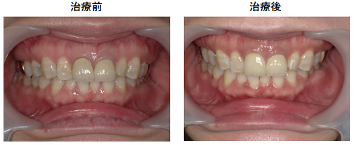 色が変わった前歯の被せ物をジルコニアで再治療した症例